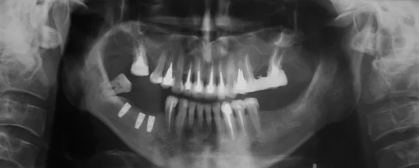 Dental x-ray
