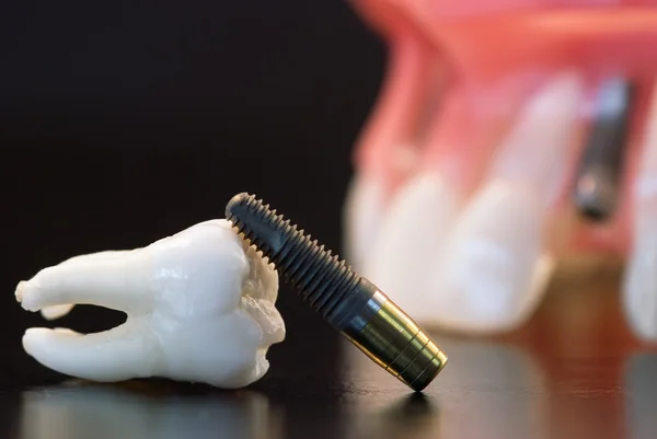 Human Wisdom tooth and Implant