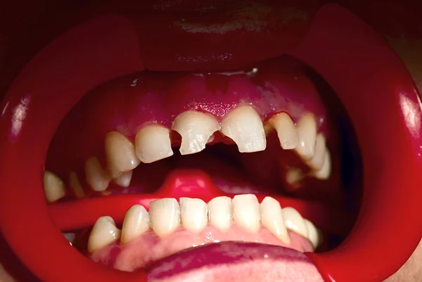 Concept: bad teeth condition