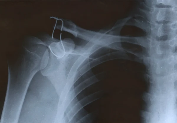 X-ray of shoulder with wire