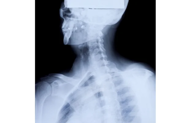 Upper Body X-ray