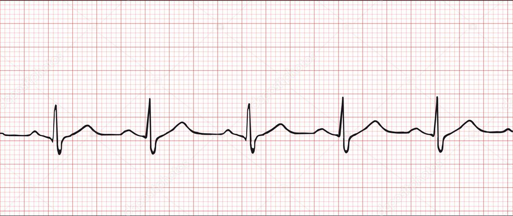 depositphotos_2124590-Electronic-cardiogram-illustration.jpg