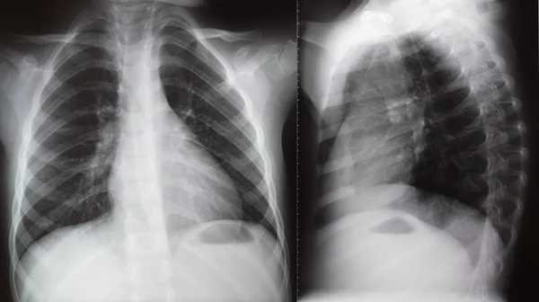Lung radiation chest Xray