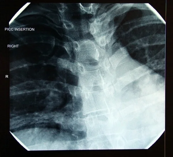 X-ray of correct PICC line insertion