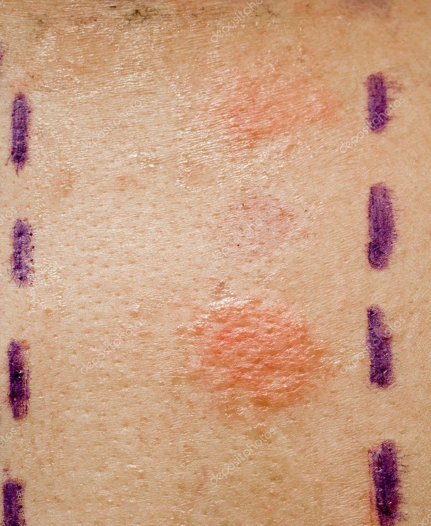 allergy on skin