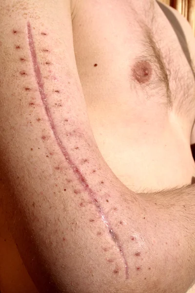 Cicatriz de operación cosida — Foto de Stock