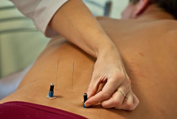 Foto van arts maken van acupunctuur op patiënt Stockfoto