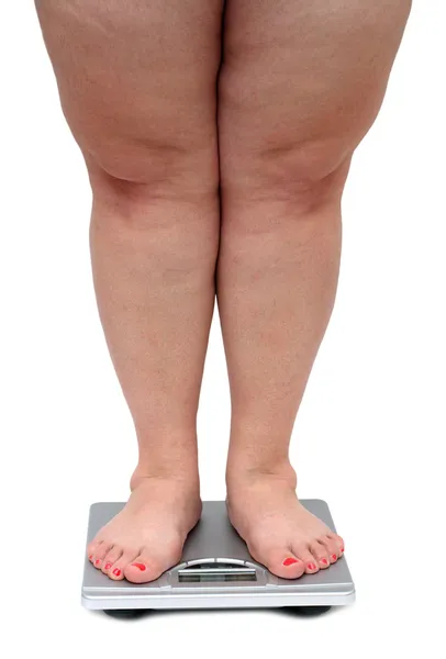 Pernas mulheres com excesso de peso — Fotografia de Stock