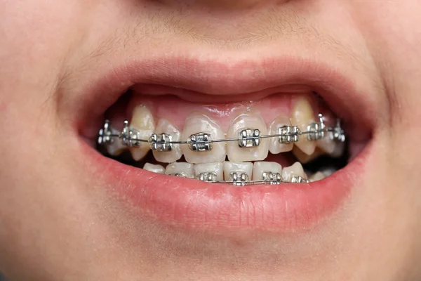 Дитячі зуби з брекетами — стокове фото