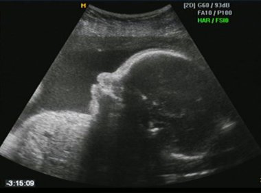 Fetus ultrasound clipart