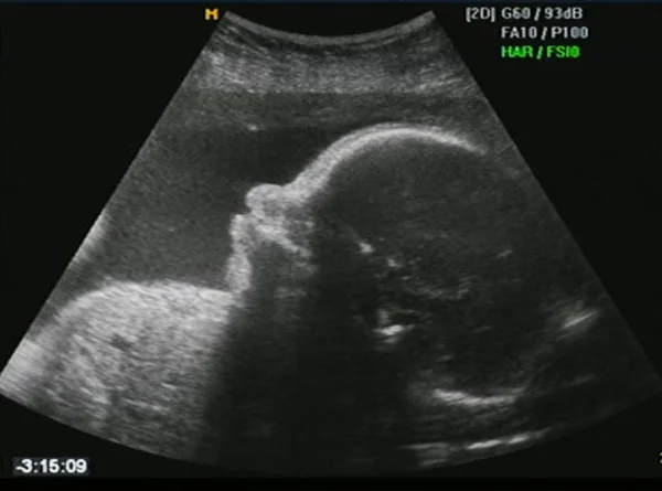 Foetus echografie — Stockfoto