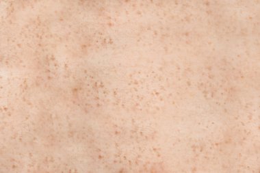 Freckled human skin clipart