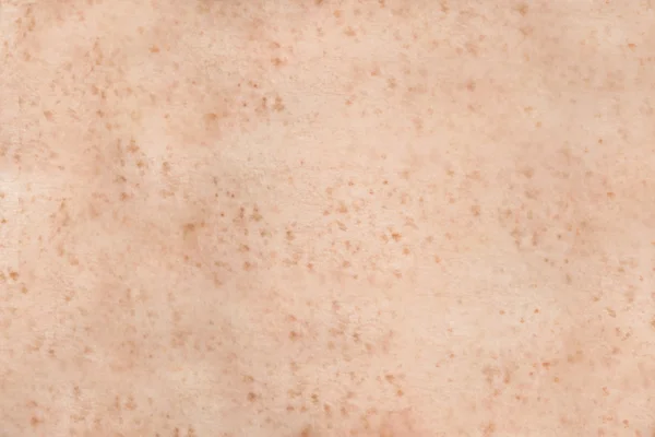 Fräknig human hud — Stockfoto