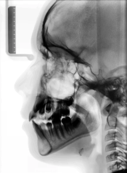 Röntgenbild des Schädels — Stockfoto