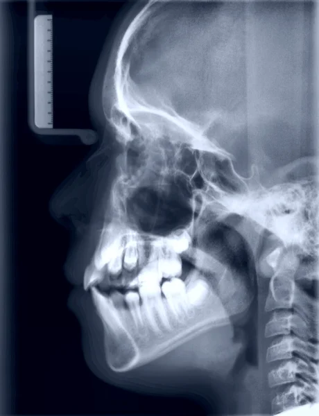 X-ray kép a koponya, a személy Jogdíjmentes Stock Fotók