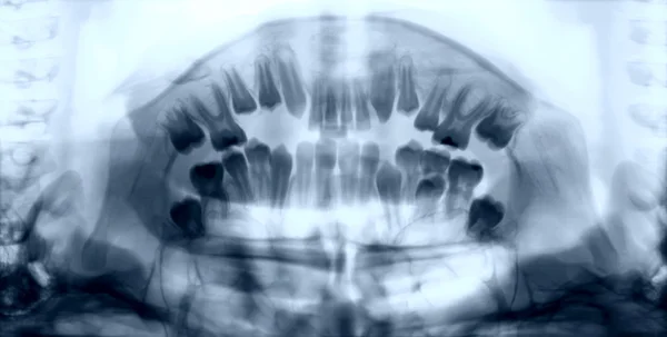 Imagen de rayos X a las mandíbulas de la — Foto de Stock