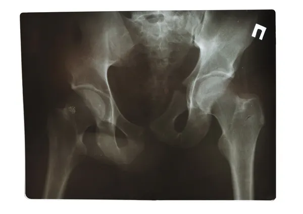 Disparo de rayos X — Foto de Stock