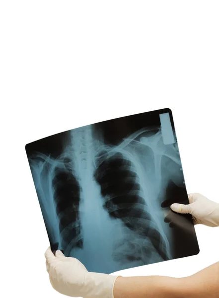 Zwei Hände mit Röntgenbild — Stockfoto