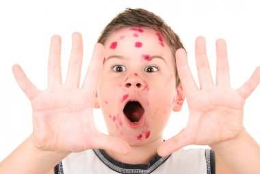 Sick chicken pox boy clipart