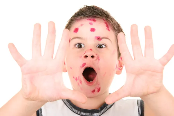 Malade varicelle garçon — Photo