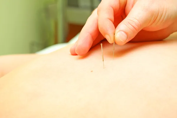 Acupuncture — Stock Photo, Image