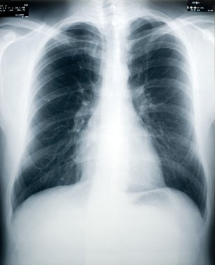 Tuberculosis Screening clipart