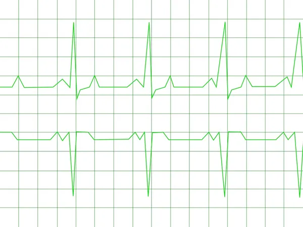 Normal Heart Rhythm — Stock Photo, Image