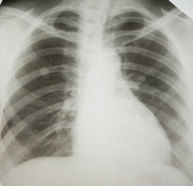 Akciğer Kanseri.