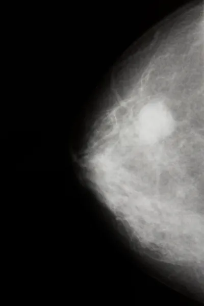 巨蟹座: 乳腺肿瘤 — 图库照片