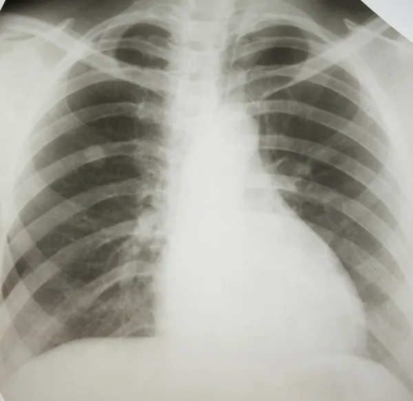 Lung cancer. — Stock Photo, Image