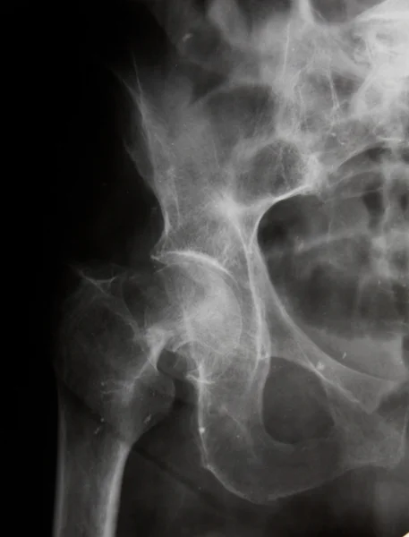 (股骨颈) 宫颈髋部骨折 — 图库照片