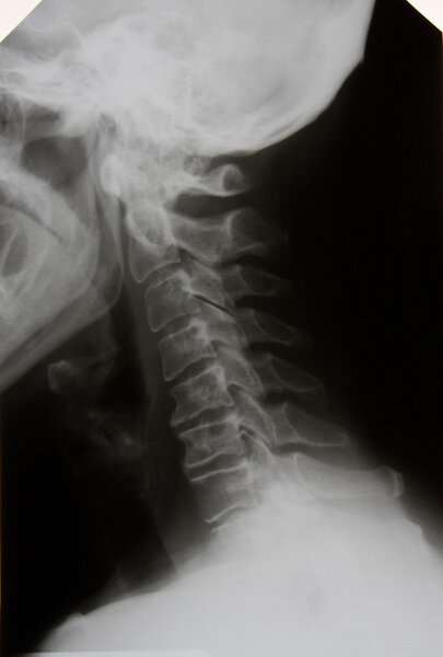 Cervical osteochondrosis III st.