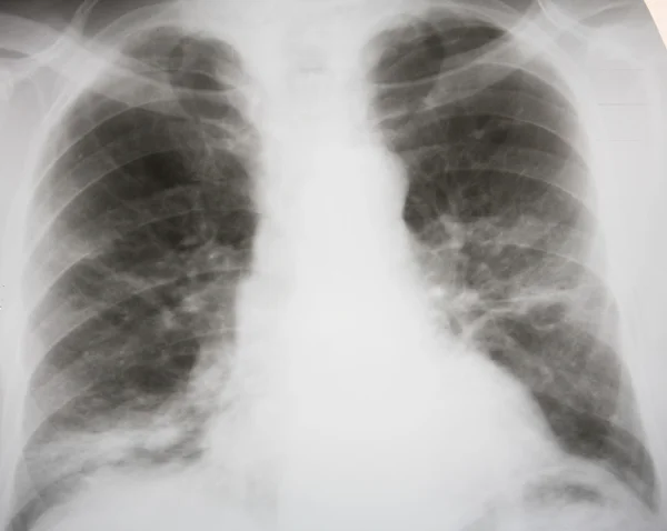 Pneumonie septică — Fotografie, imagine de stoc