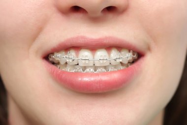 Girl smiles with braces clipart