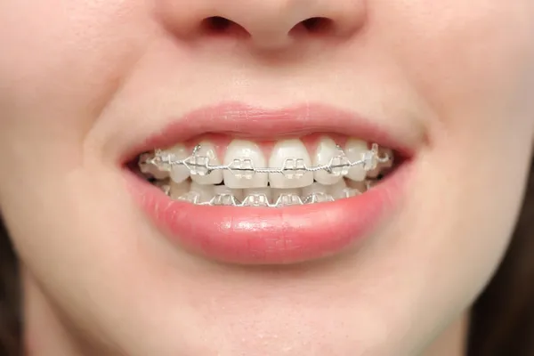 Girl smiles with braces — Stock Photo, Image