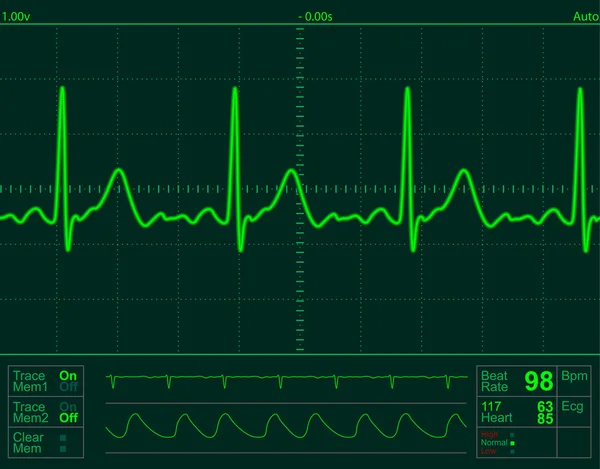 Heart monitor screen — Stock Photo, Image