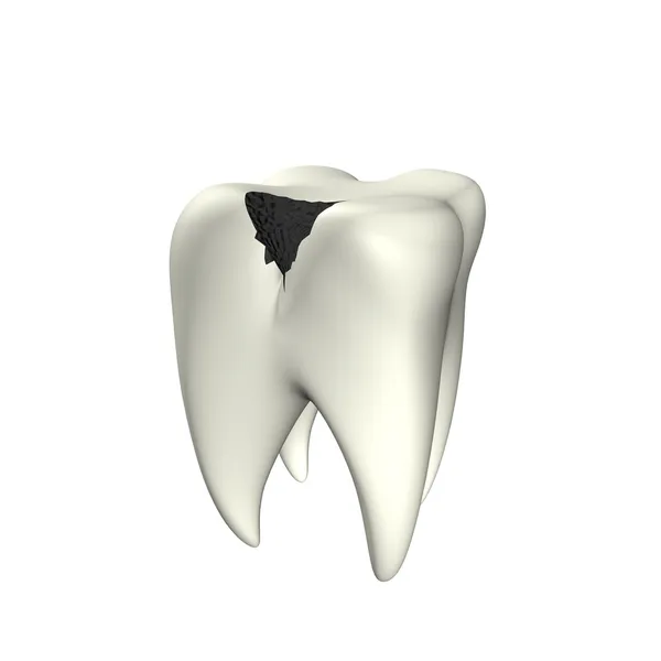 Caries dientes 3D — Foto de Stock