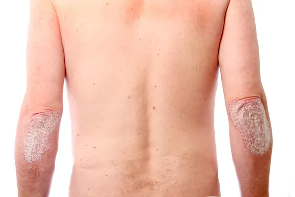 両方の肘の顕著な乾癬 — ストック写真