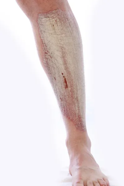 Schuppenflechte am Bein — Stockfoto