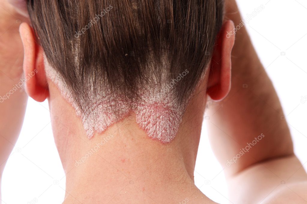 Psoriasis on the hairline