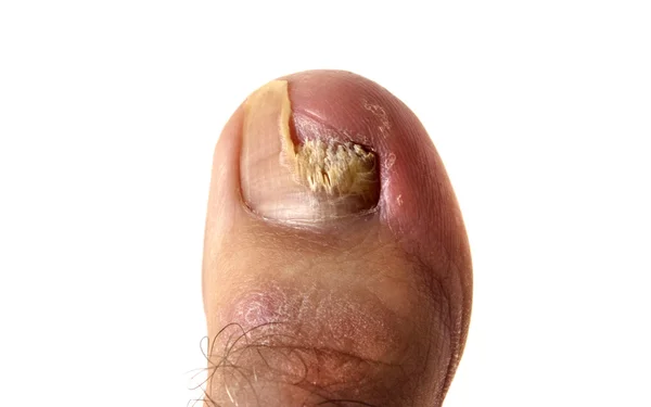 Grzyb paznokci — Zdjęcie stockowe