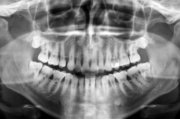 Сканирование зубов — стоковое фото