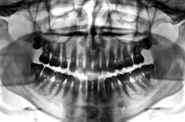 Tandheelkundige scan x-ray — Stockfoto