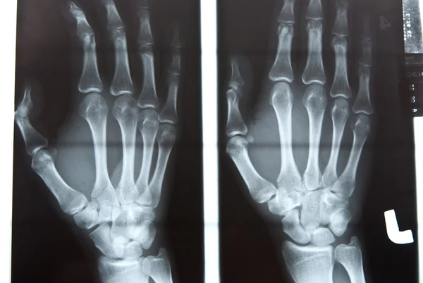 Imagem de raio-x da mão humana — Fotografia de Stock