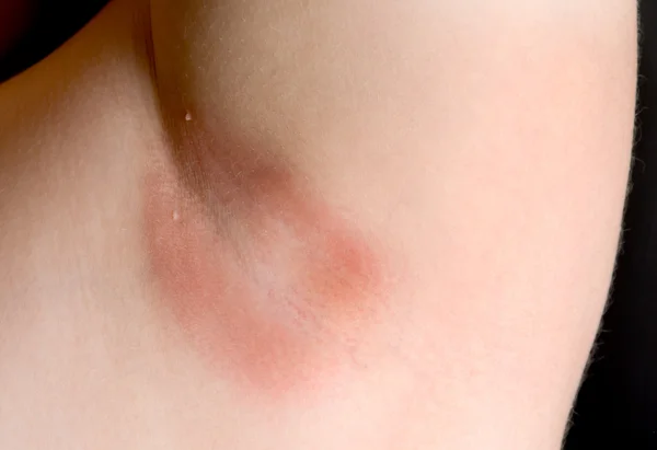 Koltukaltı mantar enfeksiyonu — Stok fotoğraf
