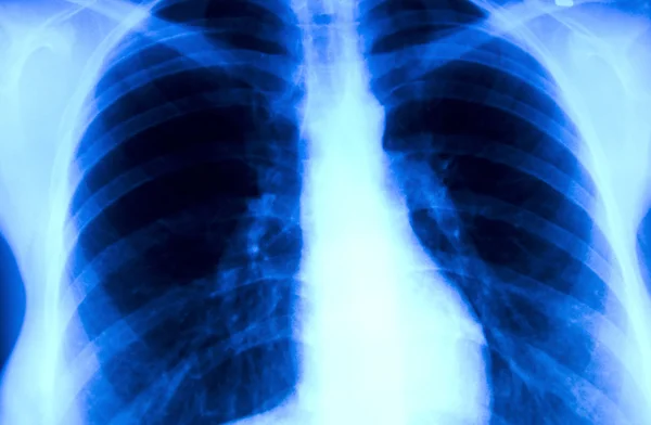 Рентгеновский торакс — стоковое фото