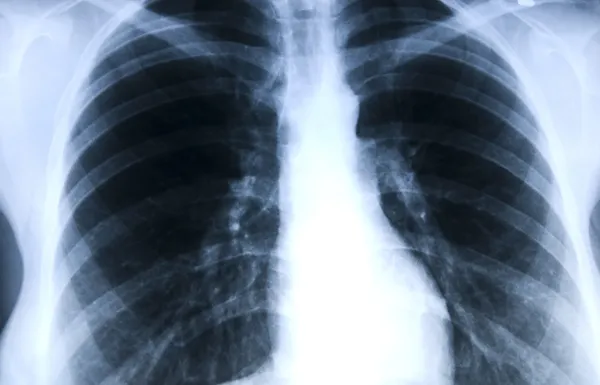 X-ray picture — Stock Photo, Image
