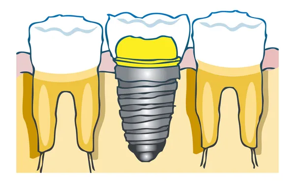 Implante dentário detalhe Ilustração médica dental — Fotografia de Stock