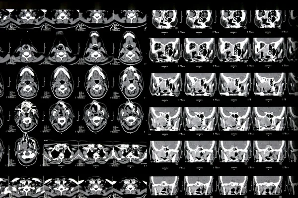 stock image Magnetic resonance of a brain