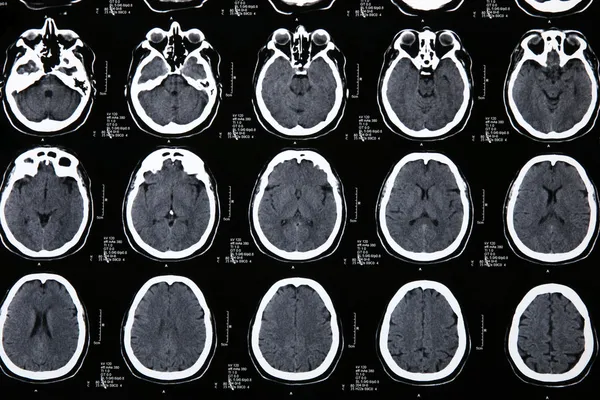Magnetic resonance of a brain — Stock Photo, Image